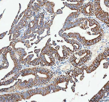 IHC analysis of CAMKK2 using anti-CAMKK2 antibody. CAMKK2 was detected in a paraffin-embedded section of human esophageal squamous carcinoma tissue. Heat mediated antigen retrieval was performed in EDTA buffer (pH 8.0, epitope retrieval solution). The tissue section was blocked with 10% goat serum. The tissue section was then incubated with 2 ug/ml rabbit anti-CAMKK2 antibody overnight at 4oC. Peroxidase Conjugated Goat Anti-rabbit IgG was used as secondary antibody and incubated for 30 min at 37oC.