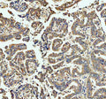 Immunohistochemical staining of FFPE human lung cancer tissue with ECE1 antibody, HRP-secondary and DAB substrate. HIER: boil tissue sections in pH8 EDTA for 20 min and allow to cool before testing.