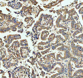 Immunohistochemical staining of FFPE human lung cancer tissue with ECE1 antibody, HRP-secondary and DAB substrate. HIER: boil tissue sections in pH8 EDTA for 20 min and allow to cool before testing.