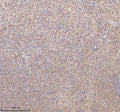 IHC analysis of SSX2IP using anti-SSX2IP antibody. SSX2IP was detected in a paraffin-embedded section of human cervix squamous cell carcinoma tissue. Heat mediated antigen retrieval was performed in EDTA buffer (pH 8.0, epitope retrieval solution). The tissue section was blocked with 10% goat serum. The tissue section was then incubated with 2 ug/ml rabbit anti-SSX2IP antibody overnight at 4oC. Peroxidase Conjugated Goat Anti-rabbit IgG was used as secondary antibody and incubated for 30 min at 37oC.
