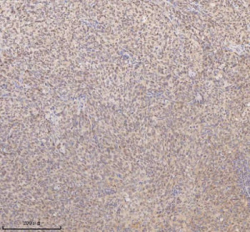IHC analysis of SSX2IP using anti-SSX2IP antibody. SSX2IP was detected in a paraffin-embedded section of human cervix squamous cell carcinoma tissue. Heat mediated antigen retrieval was performed in EDTA buffer (pH 8.0, epitope retrieval solution). The tissue section was blocked with 10% goat serum. The tissue section was then incubated with 2 ug/ml rabbit anti-SSX2IP antibody overnight at 4oC. Peroxidase Conjugated Goat Anti-rabbit IgG was used as secondary antibody and incubated for 30 min at 37oC.