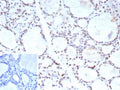 IHC staining of FFPE human prostate carcinoma tissue with FOXP1 antibody (clone FOXP1/9381R). Inset: PBS used in place of primary Ab (secondary Ab negative control). HIER: boil tissue sections in pH 9 10mM Tris with 1mM EDTA for 20 min and allow to cool before testing.
