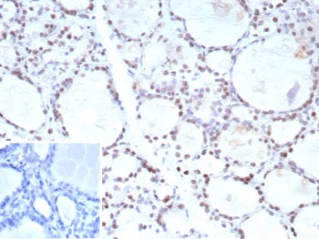 IHC staining of FFPE human prostate carcinoma tissue with FOXP1 antibody (clone FOXP1/9381R). Inset: PBS used in place of primary Ab (secondary Ab negative control). HIER: boil tissue sections in pH 9 10mM Tris with 1mM EDTA for 20 min and allow to cool before testing.
