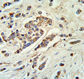 ABCC11 antibody IHC analysis in formalin fixed and paraffin embedded breast carcinoma.