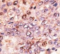 IHC analysis of FFPE human hepatocarcinoma tissue stained with the ABCB7 antibody