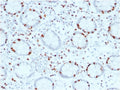 IHC testing of FFPE human colon carcinoma with SOX4 antibody (clone SOX4/2540). HIER: boil tissue sections in pH6, 10mM citrate buffer for 10-20 min and allow to cool before testing.