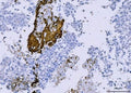 IHC staining of FFPE human lung cancer tissue with CD61 antibody. HIER: boil tissue sections in pH8 EDTA for 20 min and allow to cool before testing.