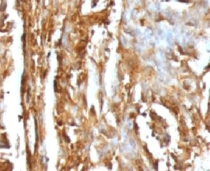IHC testing of FFPE human renal carcinoma with B2M antibody (clone MGBP2-1). FFPE testing requires sections to be boiled inpH 9 10mM Tris with 1mM EDTA for 10-20 minutes, followed by cooling at RT for 20 minutes, prior to staining.