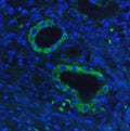Immunofluorescent staining of FFPE human lung cancer with HK1 antibody (green) and DAPI nuclear stain (blue). HIER: steam section in pH6 citrate buffer for 20 min.