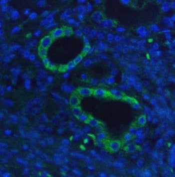 Immunofluorescent staining of FFPE human lung cancer with HK1 antibody (green) and DAPI nuclear stain (blue). HIER: steam section in pH6 citrate buffer for 20 min.