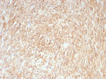 IHC testing of FFPE human gastrointestinal stromal tumor (GIST) with ANO1 antibody (clone rDG1/8750). Required HIER: boil tissue sections in pH 9 10mM Tris with 1mM EDTA for 10-20 min followed by cooling at RT for 20 min.