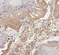 IHC staining of FFPE human intestinal cancer with SDHB antibody. HIER: boil tissue sections in pH6, 10mM citrate buffer, for 20 min and allow to cool before testing.