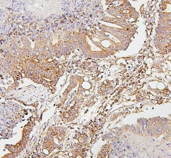 IHC staining of FFPE human intestinal cancer with SDHB antibody. HIER: boil tissue sections in pH6, 10mM citrate buffer, for 20 min and allow to cool before testing.