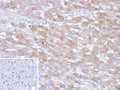 IHC staining of FFPE human hepatocellular carcinoma tissue with PHPT1 antibody (clone PHPT1/12053). Inset: PBS used in place of primary Ab (secondary Ab negative control). HIER: boil tissue sections in pH 9 10mM Tris with 1mM EDTA for 20 min and allow to cool before testing.