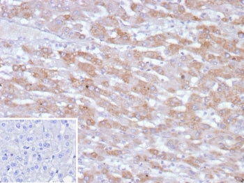 IHC staining of FFPE human hepatocellular carcinoma tissue with PHPT1 antibody (clone PHPT1/12053). Inset: PBS used in place of primary Ab (secondary Ab negative control). HIER: boil tissue sections in pH 9 10mM Tris with 1mM EDTA for 20 min and allow to cool before testing.