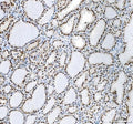 IHC staining of FFPE human thyroid cancer tissue with Nucleophosmin antibody. HIER: boil tissue sections in pH8 EDTA for 20 min and allow to cool before testing.