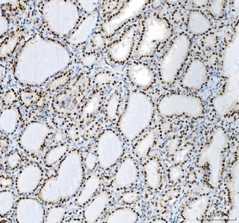 IHC staining of FFPE human thyroid cancer tissue with Nucleophosmin antibody. HIER: boil tissue sections in pH8 EDTA for 20 min and allow to cool before testing.