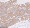 Immunohistochemical staining of COQ8B using anti-COQ8B antibody. COQ8B was detected in a paraffin-embedded section of human rectum adenocarcinoma tissue. Heat mediated antigen retrieval was performed in EDTA buffer (pH 8.0, epitope retrieval solution). The tissue section was blocked with 10% goat serum. The tissue section was then incubated with 2 ug/ml rabbit anti-COQ8B antibody overnight at 4oC. Peroxidase Conjugated Goat Anti-rabbit IgG was used as secondary antibody and incubated for 30 min at 37oC.