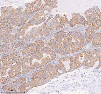 Immunohistochemical staining of COQ8B using anti-COQ8B antibody. COQ8B was detected in a paraffin-embedded section of human rectum adenocarcinoma tissue. Heat mediated antigen retrieval was performed in EDTA buffer (pH 8.0, epitope retrieval solution). The tissue section was blocked with 10% goat serum. The tissue section was then incubated with 2 ug/ml rabbit anti-COQ8B antibody overnight at 4oC. Peroxidase Conjugated Goat Anti-rabbit IgG was used as secondary antibody and incubated for 30 min at 37oC.