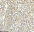 Immunohistochemical staining of PACSIN1 using anti-PACSIN1 antibody. PACSIN1 was detected in a paraffin-embedded section of human glioblastoma tissue. Heat mediated antigen retrieval was performed in EDTA buffer (pH 8.0, epitope retrieval solution). The tissue section was blocked with 10% goat serum. The tissue section was then incubated with 2 ug/ml rabbit anti-PACSIN1 antibody overnight at 4oC. Peroxidase Conjugated Goat Anti-rabbit IgG was used as secondary antibody and incubated for 30 min at 37oC.