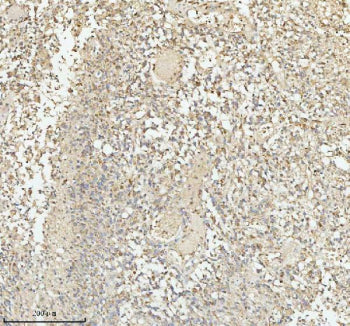 Immunohistochemical staining of PACSIN1 using anti-PACSIN1 antibody. PACSIN1 was detected in a paraffin-embedded section of human glioblastoma tissue. Heat mediated antigen retrieval was performed in EDTA buffer (pH 8.0, epitope retrieval solution). The tissue section was blocked with 10% goat serum. The tissue section was then incubated with 2 ug/ml rabbit anti-PACSIN1 antibody overnight at 4oC. Peroxidase Conjugated Goat Anti-rabbit IgG was used as secondary antibody and incubated for 30 min at 37oC.