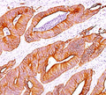IHC staining of colon carcinoma with pan Cytokeratin antibody cocktail AE1 + AE3.