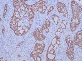 IHC staining of FFPE human lung carcinoma tissue with ROS1 antibody (clone ROS1/7999R). HIER: boil tissue sections in pH 9 10mM Tris with 1mM EDTA for 20 min and allow to cool before testing.