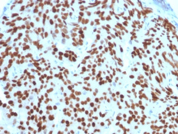 IHC staining of FFPE human prostate carcinoma with NKX3.1 antibody (clone NKX3.1/2576). HIER: boil tissue sections in pH6, 10mM citrate buffer, for 10-20 min and allow to cool before testing.