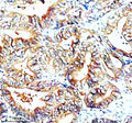 Immunohistochemical staining of SNX2 using anti-SNX2 antibody. SNX2 was detected in a paraffin-embedded section of human thyroid cancer tissue. Heat mediated antigen retrieval was performed in EDTA buffer (pH 8.0, epitope retrieval solution). The tissue section was blocked with 10% goat serum. The tissue section was then incubated with 2 ug/ml rabbit anti-SNX2 antibody overnight at 4oC. Peroxidase Conjugated Goat Anti-rabbit IgG was used as secondary antibody and incubated for 30 min at 37oC.