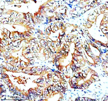 Immunohistochemical staining of SNX2 using anti-SNX2 antibody. SNX2 was detected in a paraffin-embedded section of human thyroid cancer tissue. Heat mediated antigen retrieval was performed in EDTA buffer (pH 8.0, epitope retrieval solution). The tissue section was blocked with 10% goat serum. The tissue section was then incubated with 2 ug/ml rabbit anti-SNX2 antibody overnight at 4oC. Peroxidase Conjugated Goat Anti-rabbit IgG was used as secondary antibody and incubated for 30 min at 37oC.