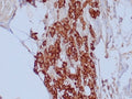IHC staining of FFPE human mesothelioma tissue with Mesothelial Cell antibody (clone HBME-1). HIER: boil tissue sections in pH 9 10mM Tris with 1mM EDTA for 20 min and allow to cool before testing.