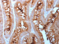 CEA Antibody Human Colon Carcinoma Tissue IHC. Immunohistochemistry analysis of CEA / CEACAM5 expression in FFPE human colon carcinoma using recombinant rabbit monoclonal antibody clone C66/1983R. This CEA antibody demonstrates strong apical membranous and luminal HRP-DAB brown staining in tumor epithelial cells forming glandular structures, with additional cytoplasmic signal, while surrounding stromal components remain largely negative; nuclei are counterstained blue.
