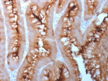 CEA Antibody Human Colon Carcinoma Tissue IHC. Immunohistochemistry analysis of CEA / CEACAM5 expression in FFPE human colon carcinoma using recombinant rabbit monoclonal antibody clone C66/1983R. This CEA antibody demonstrates strong apical membranous and luminal HRP-DAB brown staining in tumor epithelial cells forming glandular structures, with additional cytoplasmic signal, while surrounding stromal components remain largely negative; nuclei are counterstained blue.