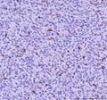 IHC staining of FFPE human glioma tissue with LPCAT2 antibody. HIER: boil tissue sections in pH8 EDTA for 20 min and allow to cool before testing.