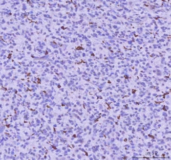 IHC staining of FFPE human glioma tissue with LPCAT2 antibody. HIER: boil tissue sections in pH8 EDTA for 20 min and allow to cool before testing.