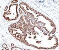 IHC testing of FFPE human breast carcinoma with HSP60 antibody (clone LK1).