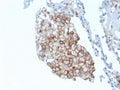 IHC staining of FFPE human lung carcinoma with CD86 antibody (clone C86/3711). HIER: boil tissue sections in pH 9 10mM Tris with 1mM EDTA for 20 min and allow to cool before testing.