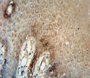 ITGA6 antibody immunohistochemistry analysis in formalin fixed and paraffin embedded human skin carcinoma.