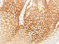 IHC testing of FFPE human cervical carcinoma with Gamma Catenin antibody (clone CTNG/1483). Required HIER: boil tissue sections in 10mM Tris with 1mM EDTA, pH 9, for 10-20 min.