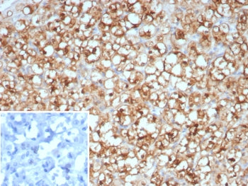 IHC staining of FFPE human renal cell carcinoma tissue with Op18 antibody (clone STMN1/8438). Inset: PBS used in place of primary Ab (secondary Ab negative control). HIER: boil tissue sections in pH 9 10mM Tris with 1mM EDTA for 20 min and allow to cool before testing.