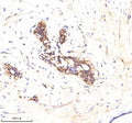 Immunohistochemical staining of ATP1A2 using anti-ATP1A2 antibody. ATP1A2 was detected in a paraffin-embedded section of human breast cancer tissue. Heat mediated antigen retrieval was performed in EDTA buffer (pH 8.0, epitope retrieval solution). The tissue section was blocked with 10% goat serum. The tissue section was then incubated with 2 ug/ml rabbit anti-ATP1A2 antibody overnight at 4oC. Peroxidase Conjugated Goat Anti-rabbit IgG was used as secondary antibody and incubated for 30 min at 37oC.