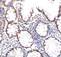 Immunohistochemical staining of MATK using anti-MATK antibody. MATK was detected in a paraffin-embedded section of human colon cancer tissue. Heat mediated antigen retrieval was performed in EDTA buffer (pH 8.0, epitope retrieval solution). The tissue section was blocked with 10% goat serum. The tissue section was then incubated with 2 ug/ml rabbit anti-MATK antibody overnight at 4oC. Peroxidase Conjugated Goat Anti-rabbit IgG was used as secondary antibody and incubated for 30 min at 37oC.