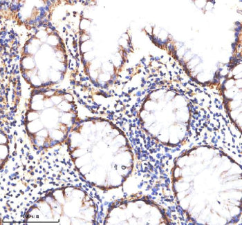 Immunohistochemical staining of MATK using anti-MATK antibody. MATK was detected in a paraffin-embedded section of human colon cancer tissue. Heat mediated antigen retrieval was performed in EDTA buffer (pH 8.0, epitope retrieval solution). The tissue section was blocked with 10% goat serum. The tissue section was then incubated with 2 ug/ml rabbit anti-MATK antibody overnight at 4oC. Peroxidase Conjugated Goat Anti-rabbit IgG was used as secondary antibody and incubated for 30 min at 37oC.