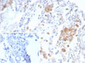 IHC staining of FFPE human lung tissue with Alpha 2 macroglobulin receptor antibody (clone LRP1/6784) Inset: PBS used in place of primary Ab (secondary Ab negative control). HIER: boil tissue sections in pH 9 10mM Tris with 1mM EDTA for 20 min and allow to cool before testing.