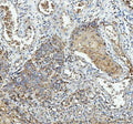 IHC staining of FFPE human esophageal squamous carcinoma tissue with IL1RA antibody. HIER: boil tissue sections in pH8 EDTA for 20 min and allow to cool before testing.