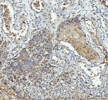 IHC staining of FFPE human esophageal squamous carcinoma tissue with IL1RA antibody. HIER: boil tissue sections in pH8 EDTA for 20 min and allow to cool before testing.