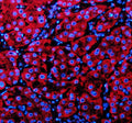 Immunofluorescent staining of PECR using anti-PECR antibody (red). PECR was detected in a paraffin-embedded section of human liver cancer tissue. Heat mediated antigen retrieval was performed in EDTA buffer (pH 8.0, epitope retrieval solution). The tissue section was blocked with 10% goat serum. The tissue section was then incubated with 5 ug/ml rabbit anti-PECR antibody overnight at 4oC. Cy3 Conjugated Goat Anti-Rabbit IgG was used as secondary antibody at 1:500 dilution and incubated for 30 min at 37oC.
