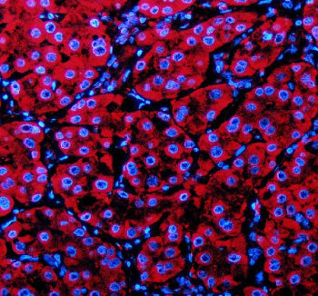 Immunofluorescent staining of PECR using anti-PECR antibody (red). PECR was detected in a paraffin-embedded section of human liver cancer tissue. Heat mediated antigen retrieval was performed in EDTA buffer (pH 8.0, epitope retrieval solution). The tissue section was blocked with 10% goat serum. The tissue section was then incubated with 5 ug/ml rabbit anti-PECR antibody overnight at 4oC. Cy3 Conjugated Goat Anti-Rabbit IgG was used as secondary antibody at 1:500 dilution and incubated for 30 min at 37oC.