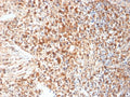 IHC staining of FFPE human cervix with HSV1 antibody (clone HSVI/2095). Required HIER: boil tissue sections in pH 9 10mM Tris with 1mM EDTA for 10-20 min followed by cooling at RT for 20 min.