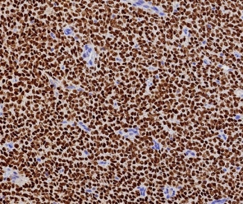 FFPE human ovarian adult granulosa cell tumor with recombinant FOXL2 antibody (clone FOXL2/7989R). HIER: boil tissue sections in pH 9 10mM Tris with 1mM EDTA for 20 min and allow to cool before testing.